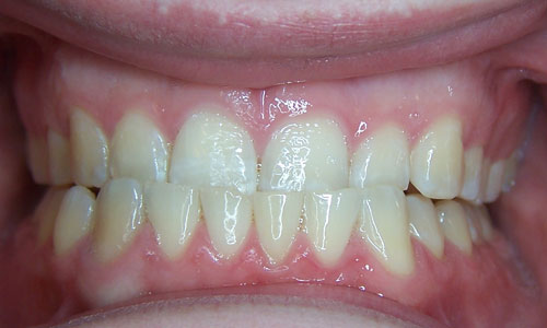 Patient smile before orthodontic treatment (case 25)