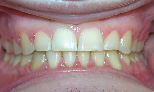 Patient smile after orthodontic treatment (case 25)