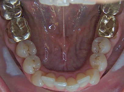 Patient smile before orthodontic treatment (case 26)