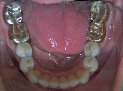 Patient smile after orthodontic treatment (case 26)