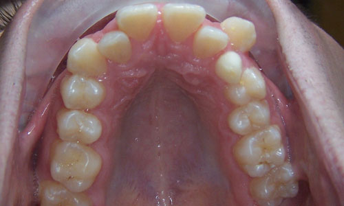 Patient smile before orthodontic treatment (case 27)