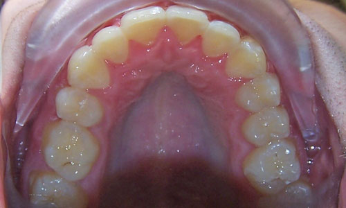 Patient smile after orthodontic treatment (case 27)