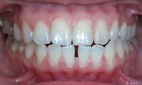 Patient smile before orthodontic treatment (case 28)
