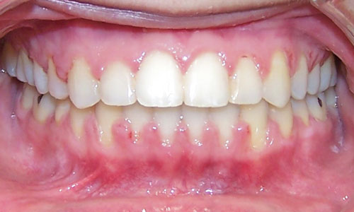Patient smile after orthodontic treatment (case 28)