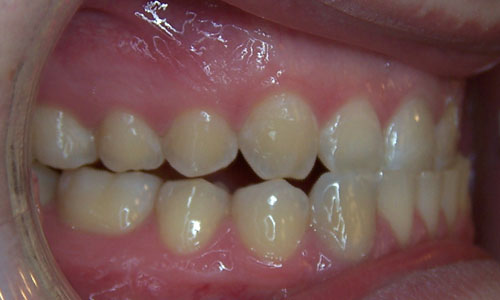 Patient smile before orthodontic treatment (case 29)
