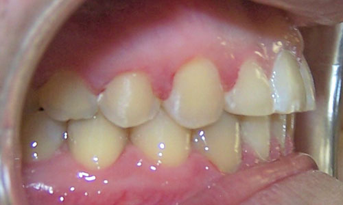 Patient smile after orthodontic treatment (case 29)