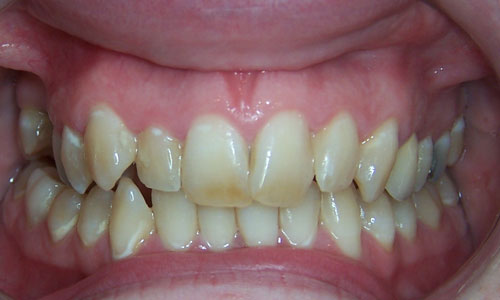 Patient smile before orthodontic treatment (case 30)
