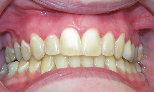 Patient smile after orthodontic treatment (case 30)