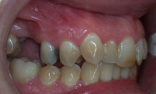 Patient smile before orthodontic treatment (case 31)