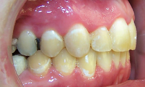 Patient smile after orthodontic treatment (case 31)