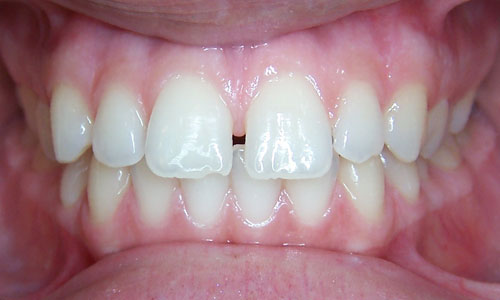Patient smile before orthodontic treatment (case 61)