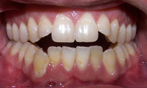 Patient smile before orthodontic treatment (case 32)