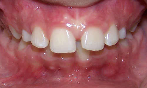 Patient smile before orthodontic treatment (case 40)