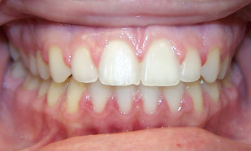 Patient smile after orthodontic treatment (case 61)