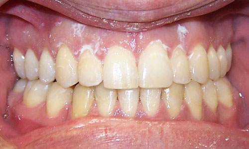 Patient smile after orthodontic treatment (case 32)
