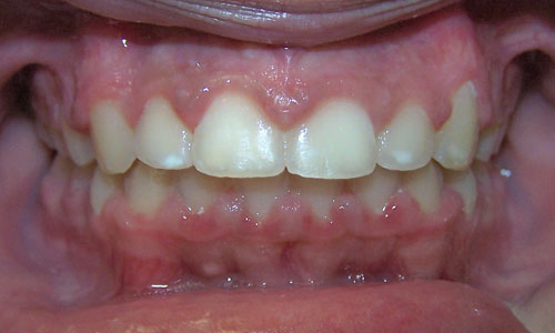 Patient smile after orthodontic treatment (case 40)