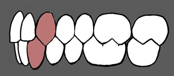 Diagram of a Class 1 canine relationship with the canines marked in red