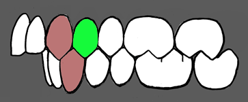 Diagram of a Class 2 bite with excessive overjet and the extraction candidate marked in green