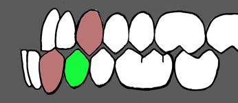 Diagram of a Class 3 bite with insufficient overjet and the extraction candidate marked in green