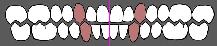 Schematic of a dental arch shown in linear form with coincident upper and lower midlines and Class I canines