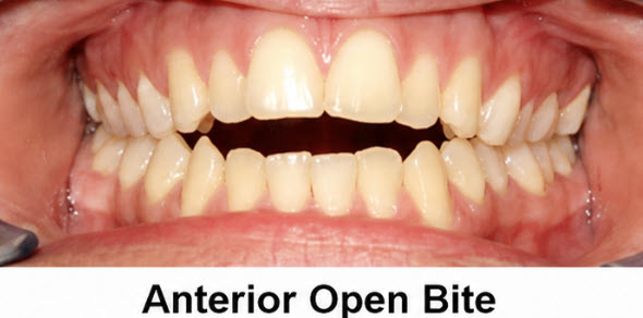Anterior open bite caused by tongue posture