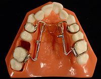 Bilateral Distal Jet appliance