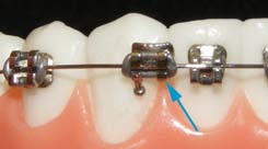 Blue arrow pointing to a loose or broken bracket on braces