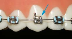 Blue arrow pointing to a bracket that is missing its elastic tie