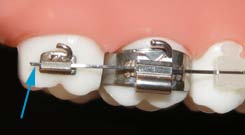 Blue arrow pointing to the end of a wire poking out behind the back molar bracket