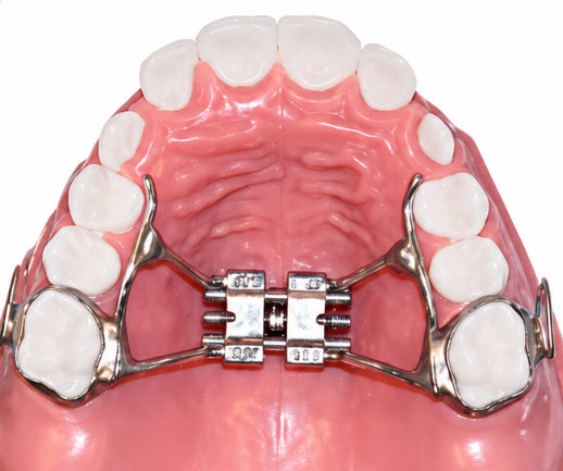 Fixed palatal expanders cemented to the upper teeth