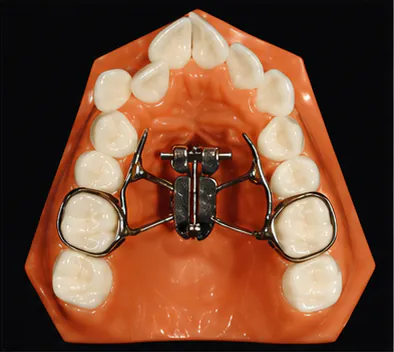 Palatal appliance