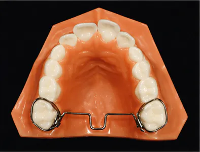 Transpalatal arch