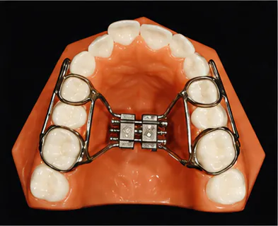Rapid palatal expander