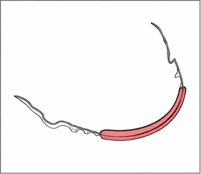 Lip bumper appliance (Figure 1)