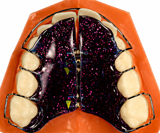 Removable jaw expander appliance