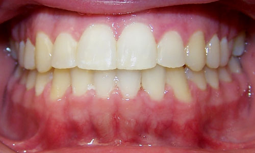 Patient smile after orthodontic treatment at The Braces Place