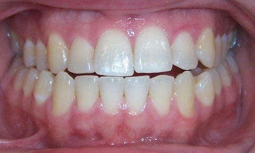 Patient smile before orthodontic treatment at The Braces Place